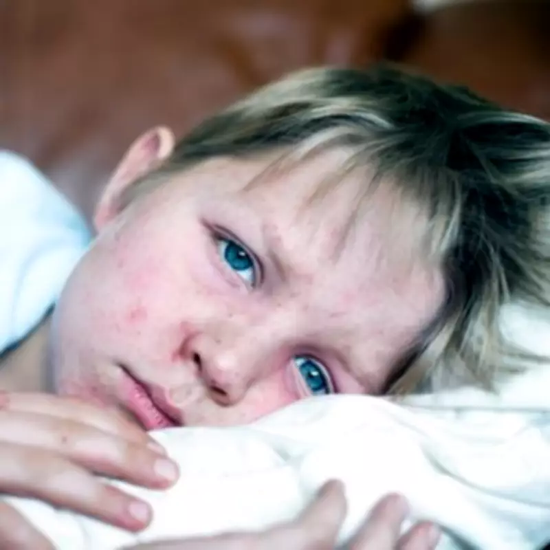 Measles Outbreak in North London Schools: Over 60 Cases Reported