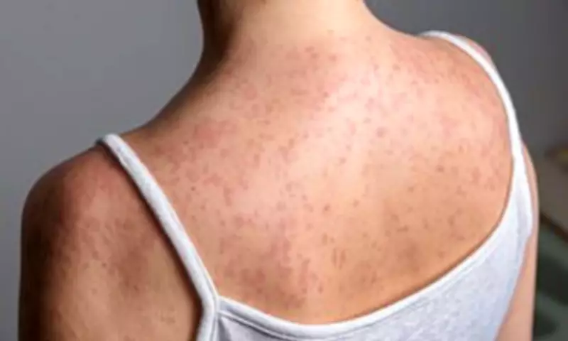 Measles Outbreak Spreads Rapidly Across North London Schools and Nurseries