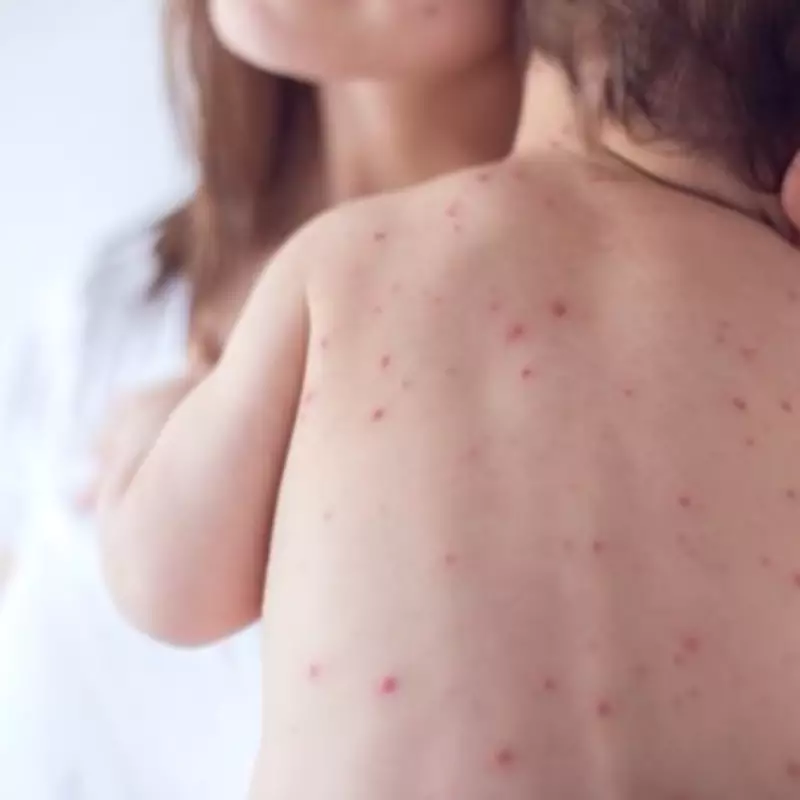 Measles Outbreak Surges Across UK: Interactive Map Reveals Local Case Numbers