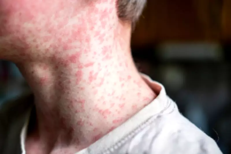 Measles Outbreak Warning: Low Vaccination Rates Threaten Children in London