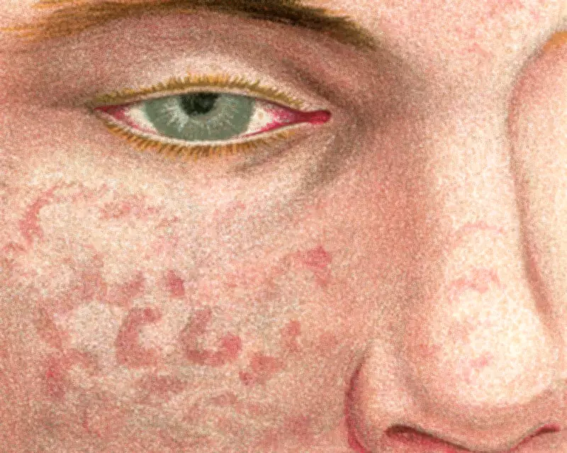 Measles Resurgence in the UK: A Lethal Threat Fueled by Declining Vaccination Rates