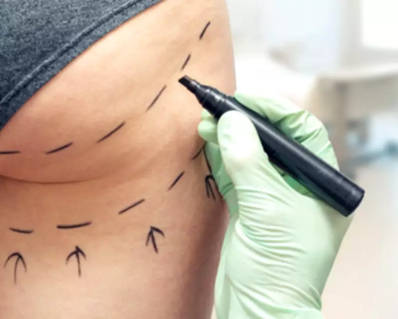 MPs Demand Ban on Brazilian Butt Lifts Amid 'Wild West' Cosmetic Industry