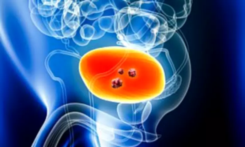 New NHS Drug Durvalumab Boosts Survival Chances for Aggressive Bladder Cancer Patients