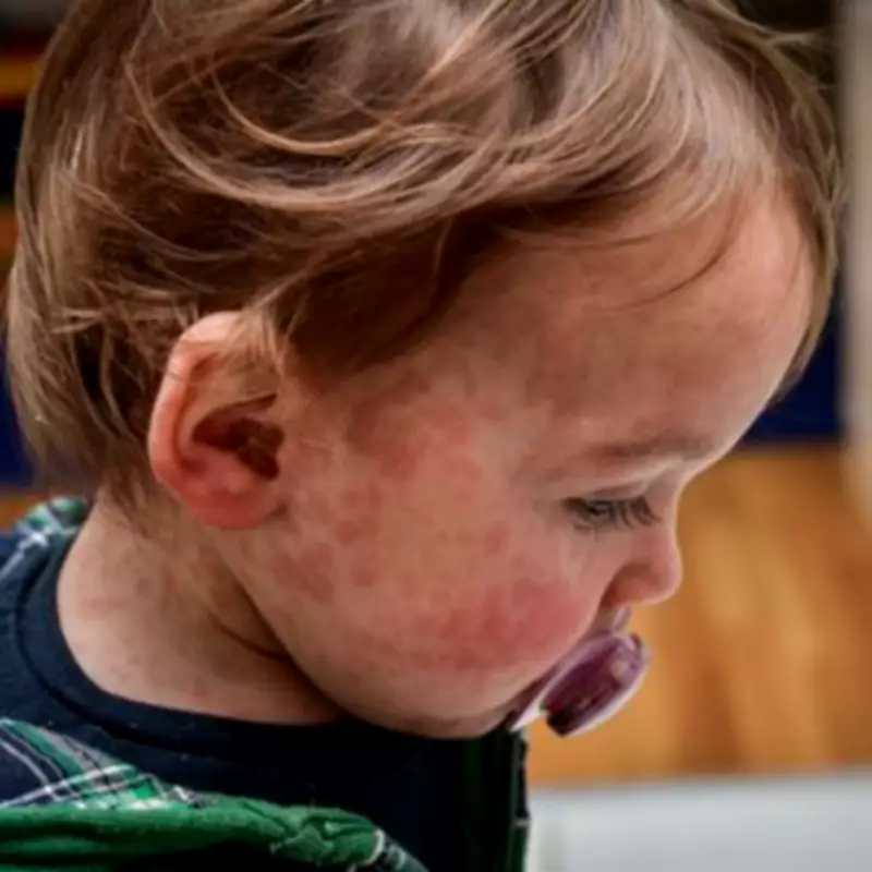 NHS Doctor Issues '90%' Measles Contagion Warning Amid UK Outbreak