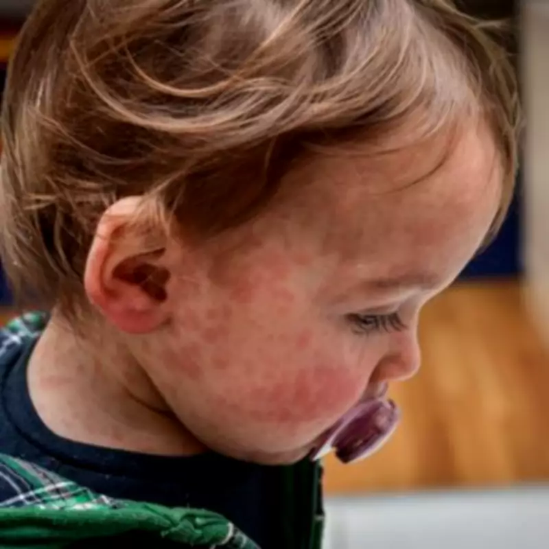 NHS Doctor Reveals Six-Month Rule for Early Measles Vaccination in Children