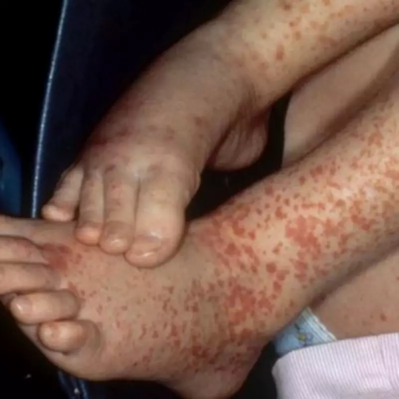 NHS Issues Critical Warning Over 'Painful' Purple Rash - Avoid Ibuprofen