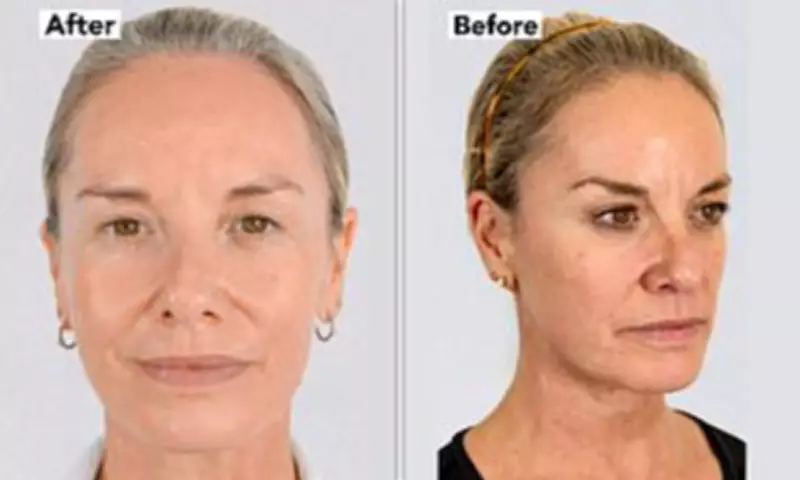 Tamzin Outhwaite Reveals £4,950 Non-Surgical Facelift Results