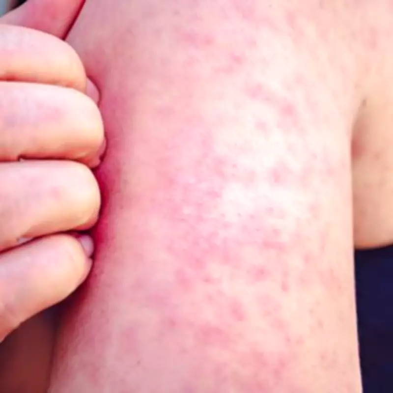 Toddler's Life-Threatening Battle with Measles After Nursery Outbreak