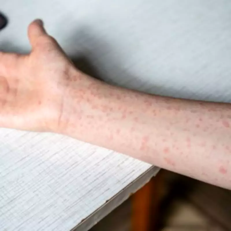 UKHSA Confirms 96 New Measles Cases, Warns of Highly Infectious Victorian Disease