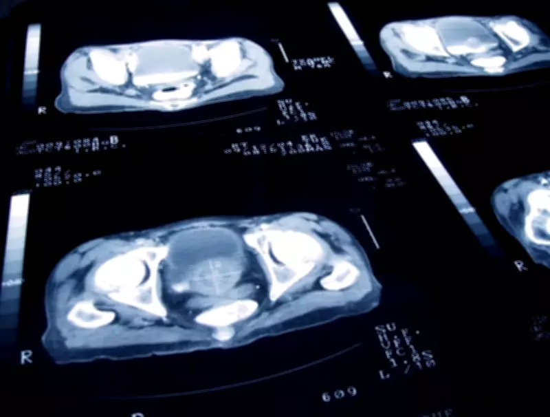 WHO Study: 7.1 Million Global Cancer Cases in 2022 Were Preventable