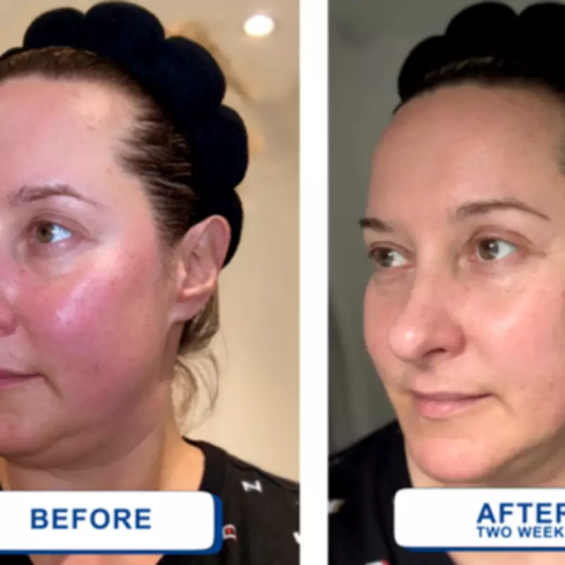 Woman's £5 Serum Transforms Rosacea-Prone Skin in Just Two Weeks
