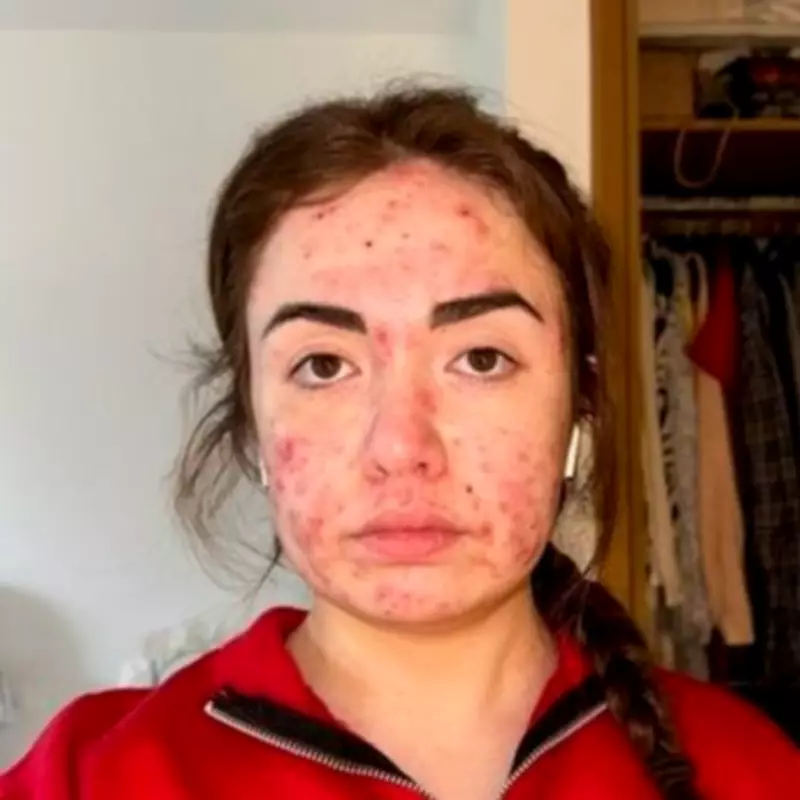 Woman's Decade-Long Acne Battle Ends with LED Phototherapy Discovery