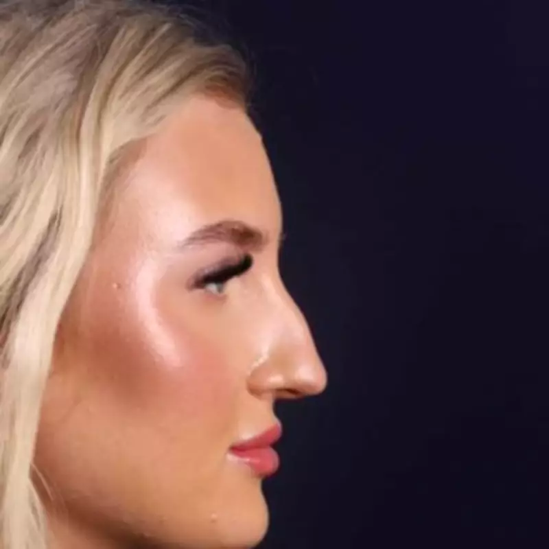 Woman's Nose Hole from Decongestant Spray Leads to Surgery in Turkey After UK Rejection