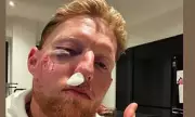 Ben Stokes Shares Shocking Injury Photo Amid Recovery and Future Plans