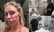 Brandi Glanville Reveals Facial Disfigurement Caused by Ruptured Breast Implants