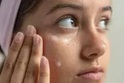 Dermatologist's Guide to Removing and Preventing Milia 'Milk Spots'