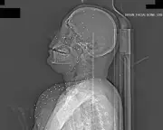 Exclusive X-Ray Analysis Reveals Catastrophic Injuries from Iran Protest Crackdown