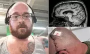 Father's Brain Tumour Misdiagnosed as Low Testosterone, Survives Against Odds