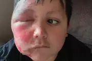 Illinois Boy Hospitalised After TikTok Toy Trend Causes Severe Facial Burns