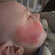 Mother's Warning After 'Safe' Detergent Caused Baby's Two-Month Facial Blister