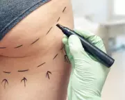 MPs Demand Ban on Brazilian Butt Lifts Amid 'Wild West' Cosmetic Industry