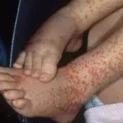 NHS Issues Critical Warning Over 'Painful' Purple Rash - Avoid Ibuprofen