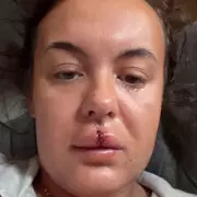 NHS Worker's Perfect Smile Destroyed in Freak Fall, Faces £8,000 Dental Bill