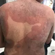 UK Health Alert: Drug-Resistant Fungal Ringworm Strain Feared Spreading