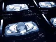 WHO Study: 7.1 Million Global Cancer Cases in 2022 Were Preventable