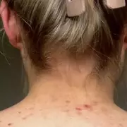 Woman Regains Confidence After Years of Hiding Body Blemishes with Skincare Routine