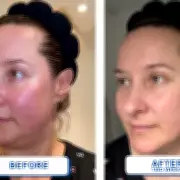 Woman's £5 Serum Transforms Rosacea-Prone Skin in Just Two Weeks