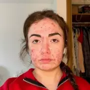 Woman's Decade-Long Acne Battle Ends with LED Phototherapy Discovery