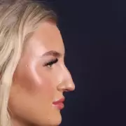 Woman's Nose Hole from Decongestant Spray Leads to Surgery in Turkey After UK Rejection