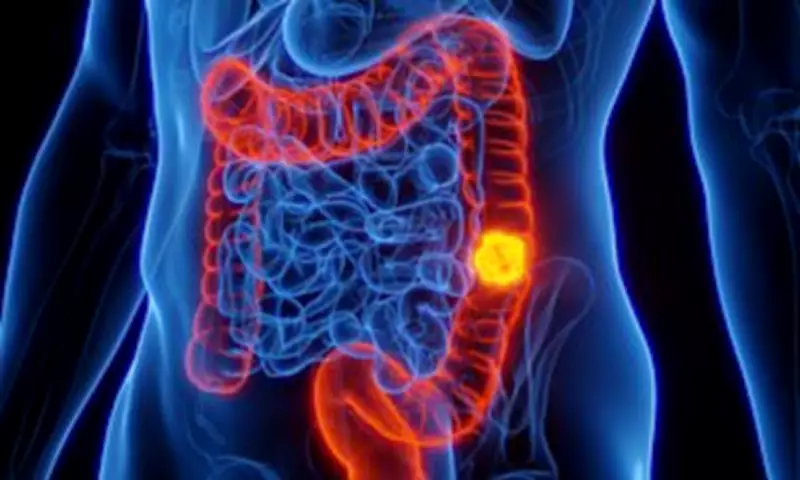 Bowel Cancer Risk Soars Among UK Youth: Experts Urge Diet and Lifestyle Changes
