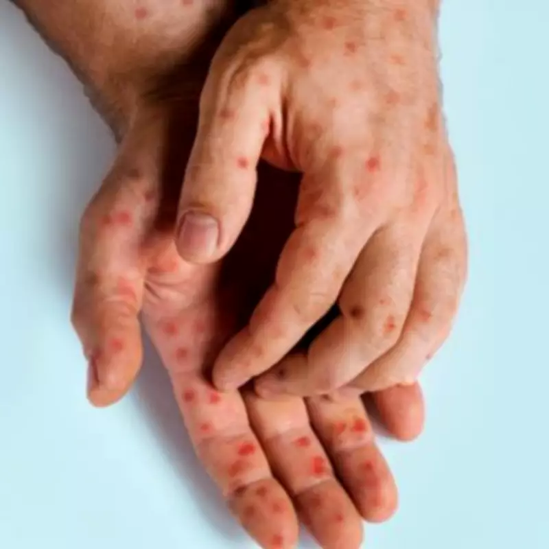 Brit Kicked Off TUI Cruise After Ringworm Mistaken for Monkeypox