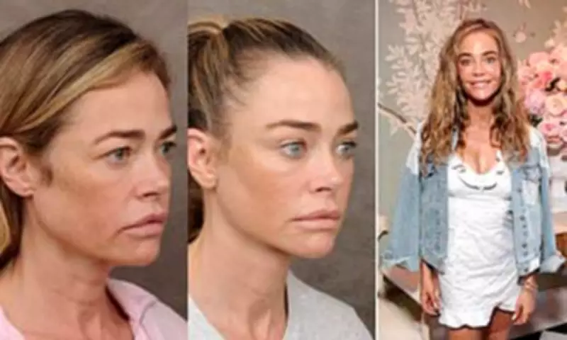 Denise Richards's Surgeon Reveals Facelift Photos Amid Divorce Drama