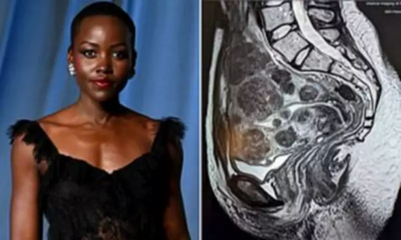 Lupita Nyong'o Reveals 77 Uterine Fibroids Battle in Emotional Birthday Essay