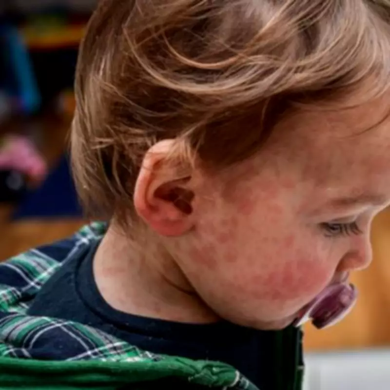 Measles Cases Surge in England, Prompting School Exclusion Warnings