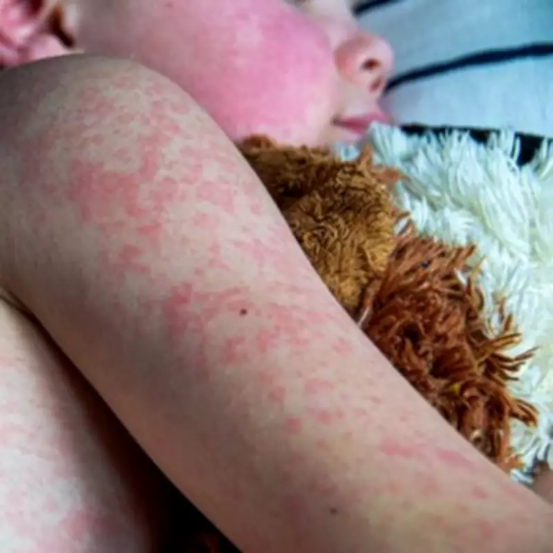 Measles Outbreak Confirmed in All English Regions, 50 Areas Affected
