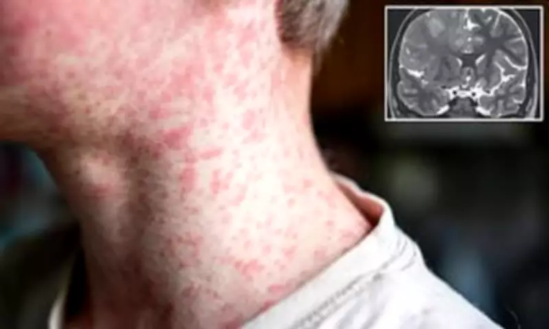 Measles Outbreak in US Reveals Deadly Long-Term Brain Complication SSPE