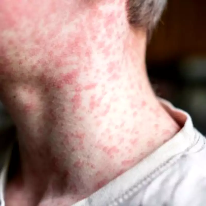 Measles Outbreak Spreads Across 50 UK Council Areas, Low Vaccination Rates Blamed