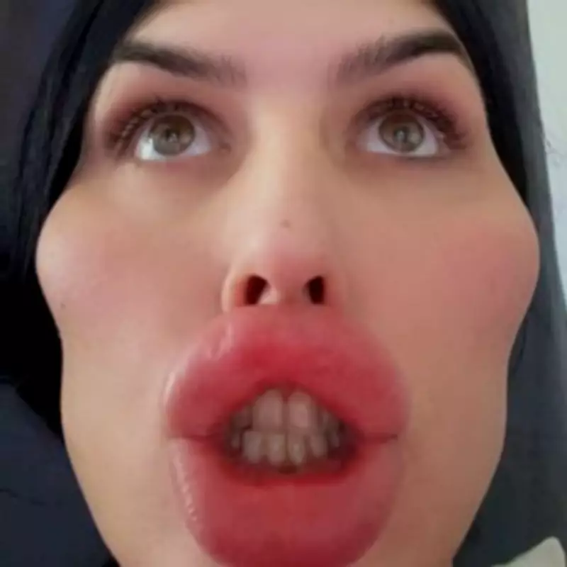 Model with 'UK's Biggest Lips' Dissolves Facial Filler After £500k Surgery Spree