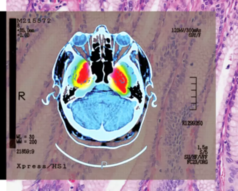 Shingles Vaccine Shows Strong Evidence of Lowering Dementia Risk, Study Finds