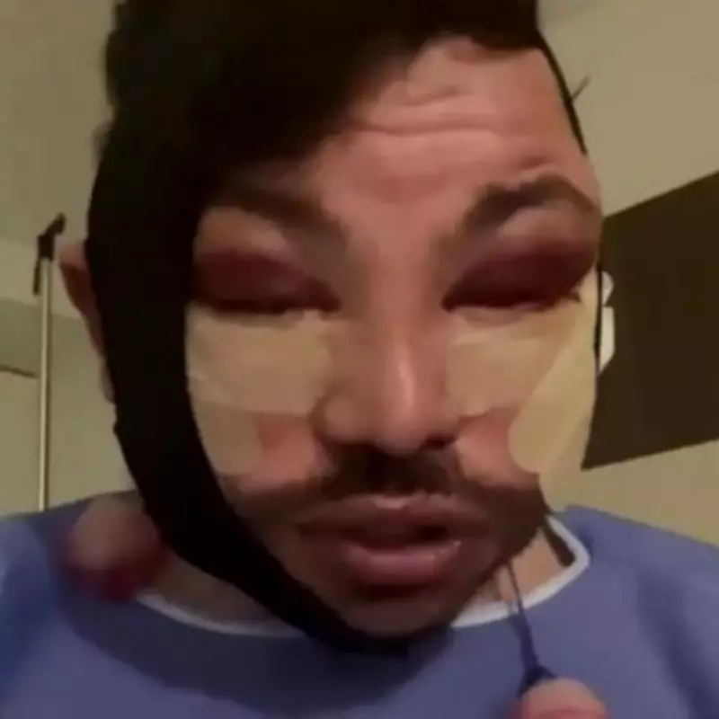 TOWIE's Bobby Norris Stuns Fans with Bruised Post-Surgery Appearance