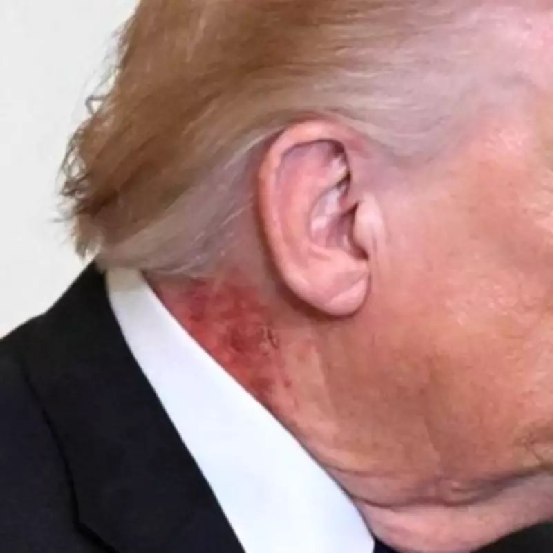 Trump's Health Riddles: From Neck Scabs to Hidden Bruises and Lumps