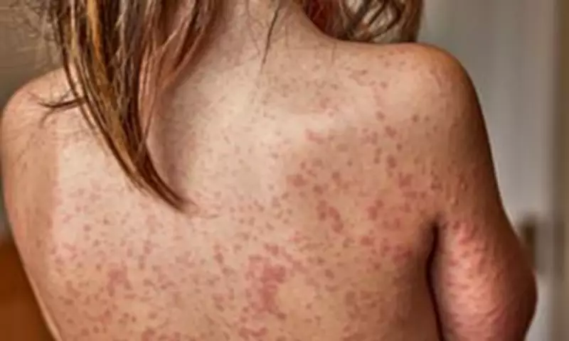 Unvaccinated Pupils Face School Exclusion Amid London Measles Outbreak
