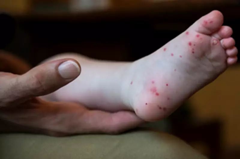 Vietnam Hand, Foot and Mouth Outbreak Claims Three Lives, 7,300 Cases Reported