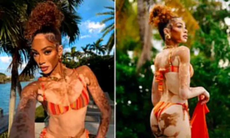 Winnie Harlow Sizzles in Vibrant Bikini While Promoting Sun Care Brand