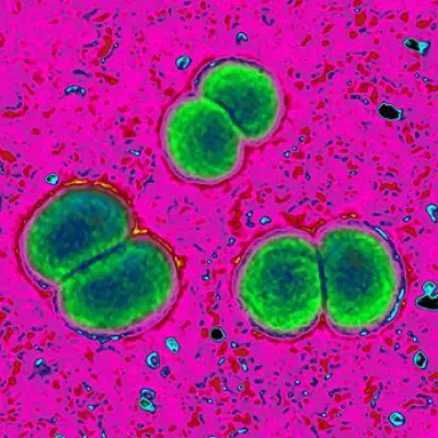 Meningitis Case Confirmed in Cork Student, No Link to UK Outbreak