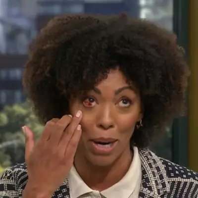 This Morning's Dr Zoe Explains Mystery Eye Injury Amid Meningitis Outbreak